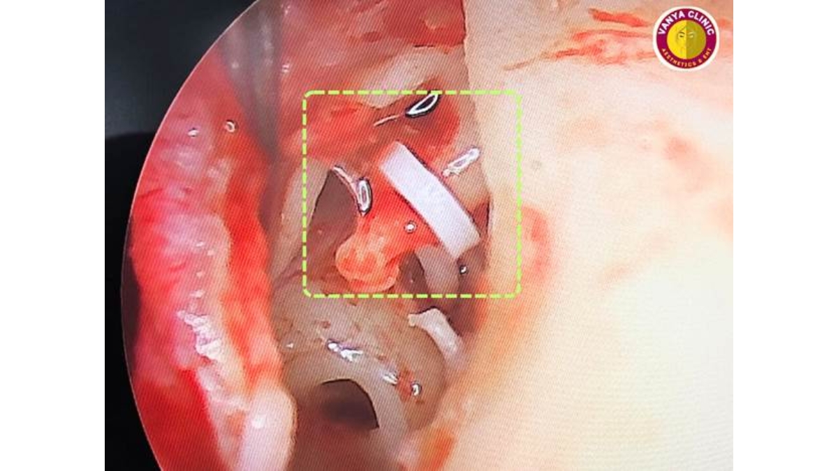 Dr. Purodha Prasad, Leading ENT Specialist in Delhi, Reverses Years of Hearing Loss with Precision Ear Surgery-PNN