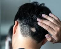 Alopecia Areata Homeopathy Treatment Offers Hope for Adults and Adolescents