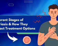 Different Stages of Psoriasis and How They Impact Treatment Options