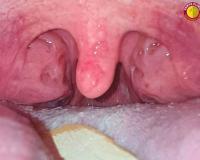 From Mama – Baba to Thank You Doctor : Dr. Purodha Prasad ENT Surgery Changes a Young Life in Delhi NCR