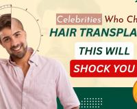 Celebrity Hair Transplant: You’d Never Guess They Had a Hair Transplant- But They Did