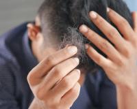 What Are the Main Causes of Hair Fall in Men?