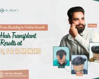 From Shedding to Visible Growth: Hair Transplant Results at 3, 6 and 12 Months