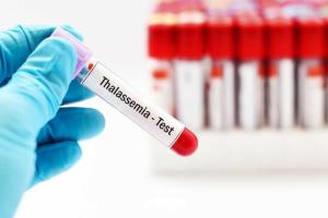 Thalassemia: A Major Health Concern in India
