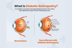 Can Diabetic Retinopathy Be Reversed?