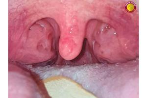 From Mama – Baba to Thank You Doctor : Dr. Purodha Prasad ENT Surgery Changes a Young Life in Delhi NCR