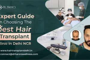 Expert Guide on Choosing the Best Hair Transplant Clinic in Delhi NCR