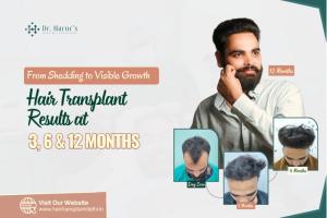 From Shedding to Visible Growth: Hair Transplant Results at 3, 6 and 12 Months